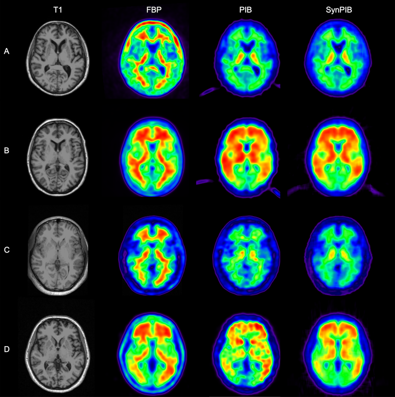 composite image of positron emission tomography images of human brains